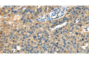 Immunohistochemistry of paraffin-embedded Human breast cancer tissue using DHCR24 Polyclonal Antibody at dilution 1:40 (Seladin 1 抗体)
