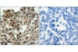 Immunohistochemistry analysis of paraffin-embedded human breast carcinoma tissue, using FKHRL1 (Ab-253) Antibody. (FOXO3 抗体  (AA 220-269))