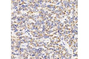 Immunohistochemistry analysis of paraffin-embedded human liver cancer using AGXT (ABIN7072987) at dilution of 1: 2000 (AGXT 抗体)