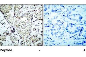 Immunohistochemical analysis of paraffin-embedded human breast carcinoma tissue using MAP2K6 polyclonal antibody . (MAP2K6 抗体  (Ser207))