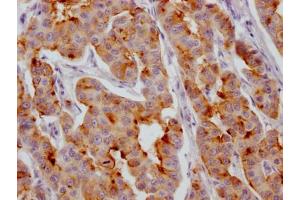 IHC image of ABIN7127563 diluted at 1:100 and staining in paraffin-embedded human breast cancer performed on a Leica BondTM system. (Recombinant IGFBP2 抗体)