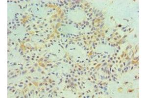 Immunohistochemistry (IHC) image for anti-Melanoma Antigen Family A, 1 (Directs Expression of Antigen MZ2-E) (MAGEA1) (AA 1-309) antibody (ABIN7159251)
