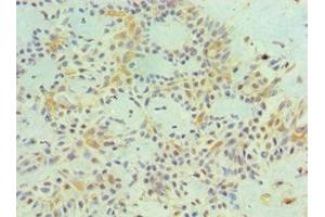 Immunohistochemistry of paraffin-embedded human breast cancer using ABIN7159251 at dilution of 1:100 (MAGEA1 抗体  (AA 1-309))