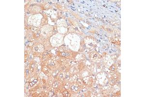 Immunohistochemistry of paraffin-embedded human liver cancer using RIPK3 antibody (ABIN6132598, ABIN6146964, ABIN6146967 and ABIN6221084) at dilution of 1:100 (40x lens). (RIPK3 抗体  (AA 1-120))