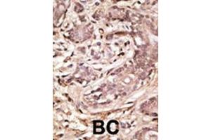 Formalin-fixed and paraffin-embedded human cancer tissue reacted with the primary antibody, which was peroxidase-conjugated to the secondary antibody, followed by AEC staining. (SUMO4 抗体  (AA 34-63))