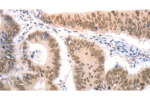 Immunohistochemistry of paraffin-embedded Human colon cancer tissue using RAD52 Polyclonal Antibody at dilution 1:50 (RAD52 抗体)
