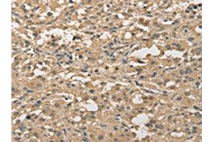 The image on the left is immunohistochemistry of paraffin-embedded Human thyroid cancer tissue using ABIN7128351(ALDH8A1 Antibody) at dilution 1/30, on the right is treated with fusion protein. (ALDH8A1 抗体)