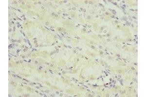 Immunohistochemistry of paraffin-embedded human gastric cancer using ABIN7151252 at dilution of 1:100 (TRIM23 抗体  (AA 1-280))