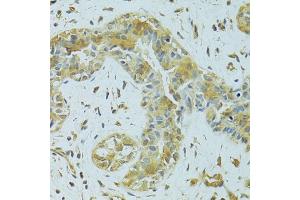 Immunohistochemistry of paraffin-embedded human breast cancer using MTCH1 antibody (ABIN5975695) at dilution of 1/100 (40x lens). (MTCH1 抗体)