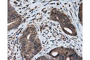 Immunohistochemical staining of paraffin-embedded Adenocarcinoma of colon tissue using anti-MTRF1L mouse monoclonal antibody. (MTRF1L 抗体)