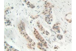 IHC-P analysis of Human Breast cancer Tissue, with DAB staining. (HMGB1 抗体  (AA 1-215))