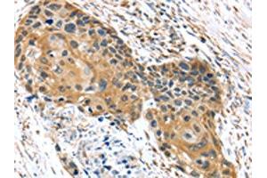 The image on the left is immunohistochemistry of paraffin-embedded Human esophagus cancer tissue using ABIN7192977(UBTD1 Antibody) at dilution 1/30, on the right is treated with synthetic peptide. (UBTD1 抗体)