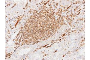IHC-P Image Immunohistochemical analysis of paraffin-embedded human gastric cancer, using alpha Actin (cardiac muscle), antibody at 1:100 dilution. (ACTC1 抗体)