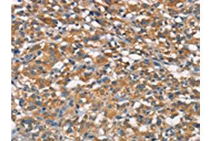 The image on the left is immunohistochemistry of paraffin-embedded Human thyroid cancer tissue using ABIN7189845(APOA1BP Antibody) at dilution 1/15, on the right is treated with synthetic peptide. (APOA1BP 抗体)