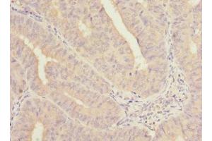 Immunohistochemistry of paraffin-embedded human endometrial cancer using ABIN7161139 at dilution of 1:100 (COBRA1 抗体  (AA 8-199))