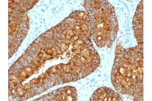Formalin-fixed, paraffin-embedded human Colon Carcinoma stained with MAML3 Monoclonal Antibody (MAML3/1303). (MAML3 抗体)