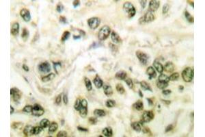 Immunohistochemistry analyzes of SMAP45 antibody in paraffin-embedded human breast carcinoma tissue. (HDAC3 抗体)