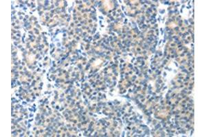The image on the left is immunohistochemistry of paraffin-embedded Human thyroid cancer tissue using ABIN7128892(CEACAM1 Antibody) at dilution 1/25, on the right is treated with fusion protein. (CEACAM1 抗体)