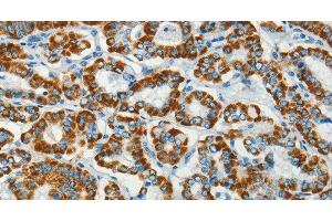 Immunohistochemistry of paraffin-embedded Human thyroid cancer using BCAT2 Polyclonal Antibody at dilution of 1:70 (BCAT2 抗体)