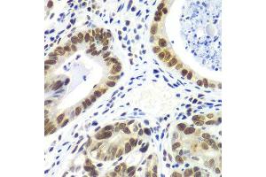 Immunohistochemistry of paraffin-embedded human gastric cancer using RNF2 antibody. (RNF2 抗体  (AA 1-336))