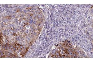 ABIN6275973 at 1/100 staining Human urothelial cancer tissue by IHC-P. (BAI1 抗体  (Internal Region))