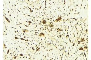 ABIN6269246 at 1/100 staining Human breast cancer tissue by IHC-P. (STAT6 抗体  (Internal Region))