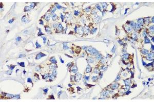 Immunohistochemistry of paraffin-embedded Human breast cancer using KMT2E Polyclonal Antibody at dilution of 1:200 (40x lens). (MLL5/KMT2E 抗体)
