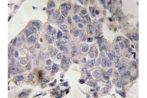 Immunohistochemistry analyzes of STAM2 antibody in paraffin-embedded human lung carcinoma tissue. (STAM2 抗体)