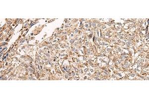 Immunohistochemistry of paraffin-embedded Human lung cancer tissue using NDUFB11 Polyclonal Antibody at dilution of 1:95(x200) (NDUFB11 抗体)