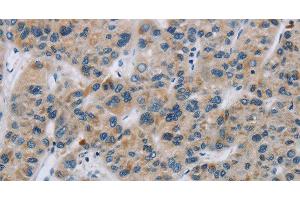 Immunohistochemistry of paraffin-embedded Human liver cancer using SYN2 Polyclonal Antibody at dilution of 1:40 (SYN2 抗体)