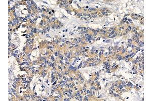 ABIN6261841 and ABIN6278571 at 1/100 staining human colorectal cancer by IHC-P. (FZD7 抗体  (C-Term))
