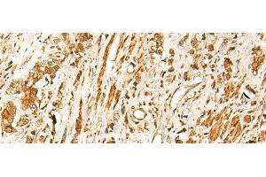 Immunohistochemistry of paraffin-embedded Human prost ate cancer tissue using TCF7 Polyclonal Antibody at dilution of 1:30(x200) (TCF7 抗体)