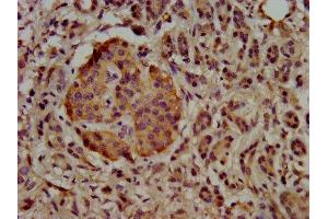 IHC image of ABIN7174451 diluted at 1:500 and staining in paraffin-embedded human pancreatic cancer performed on a Leica BondTM system. (UBE2G1 抗体  (AA 2-170))