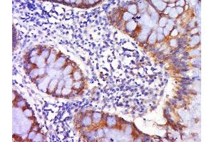 Paraformaldehyde-fixed, paraffin embedded human colon carcinoma tissue, Antigen retrieval by boiling in sodium citrate buffer(pH6) for 15min, Block endogenous peroxidase by 3% hydrogen peroxide for 30 minutes, Blocking buffer (normal goat serum) at 37°C for 20min, Antibody incubation with Rabbit Anti-DR4 Polyclonal Antibody, Unconjugated  at 1:500 overnight at 4°C, followed by a conjugated secondary and DAB staining (DR4 抗体  (AA 401-468))