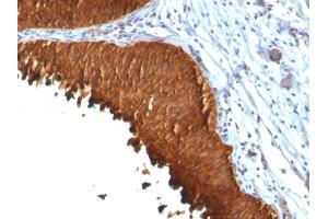 Formalin-fixed, paraffin-embedded human Bladder Carcinoma stained with Cytokeratin 19 Monoclonal Antibody (KRT19/799 + KRT19/800) (Cytokeratin 19 抗体)