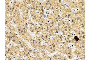 ABIN6257043 and ABIN6275490 at 1/100 staining human liver cancer by IHC-P.