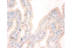 Immunohistochemistry of paraffin-embedded human bladder cancer using ABIN7162048 at dilution of 1:50 (NME1 抗体  (AA 2-152))