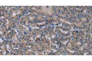 Immunohistochemistry of paraffin-embedded Human thyroid cancer tissue using HSPG2 Polyclonal Antibody at dilution 1:50 (HSPG2 抗体)