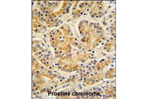 MOBKL1B Antibody IHC analysis in formalin fixed and paraffin embedded human Prostate carcinoma followed by peroxidase conjugation of the secondary antibody and DAB staining.
