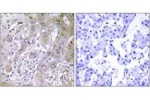 Immunohistochemistry analysis of paraffin-embedded human liver carcinoma tissue, using ACOT12 Antibody. (ACOT12 抗体  (AA 281-330))