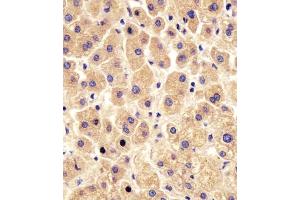 (ABIN6243863 and ABIN6578454) staining PYGL in human liver tissue sections by Immunohistochemistry (IHC-P - paraformaldehyde-fixed, paraffin-embedded sections). (PYGL 抗体  (AA 809-843))