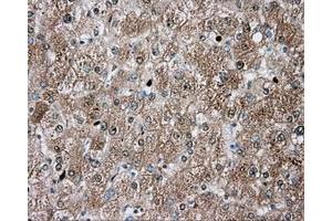 Immunohistochemical staining of paraffin-embedded Carcinoma of liver tissue using anti-TPMT mouse monoclonal antibody. (TPMT 抗体)