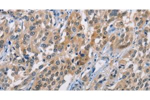 Immunohistochemistry of paraffin-embedded Human esophagus cancer using CBR1 Polyclonal Antibody at dilution of 1:40 (CBR1 抗体)