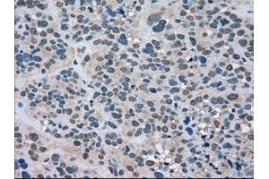 Immunohistochemical staining of paraffin-embedded Carcinoma of kidney tissue using anti-LDHAmouse monoclonal antibody. (Lactate Dehydrogenase A 抗体)