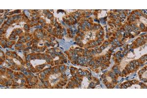 Immunohistochemistry of paraffin-embedded Human thyroid cancer using MRPL28 Polyclonal Antibody at dilution of 1:45 (MRPL28 抗体)