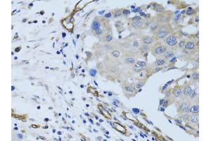 Immunohistochemistry of paraffin-embedded human breast cancer using MCAM antibody. (MCAM 抗体)