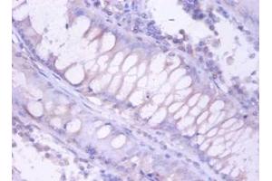 Immunohistochemistry of paraffin-embedded human colorectal carcinoma using PSMB4 antibody at dilution of 1:100. (PSMB4 抗体)