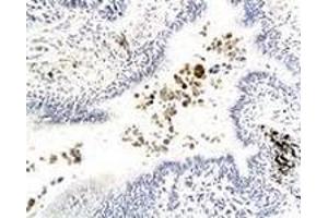 Immunohistochemiacl staining of human lung carcinoma tissue section with GPR182 polyclonal antibody  at 1:200 dilution. (G Protein-Coupled Receptor 182 抗体)