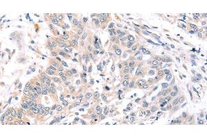 Immunohistochemistry of paraffin-embedded Human lung cancer tissue using ROR1 Polyclonal Antibody at dilution 1:45 (ROR1 抗体)