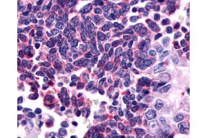 Anti-GPR162 antibody IHC of human Lung, Small Cell Carcinoma. (GPR162 抗体  (Extracellular Domain))
